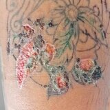 Skin Conditions, Tattoo Ink Retention, & Healing